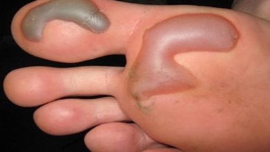 Photo of Bolhas, calos e outros problemas doloridos nos dedos dos pés de corredores