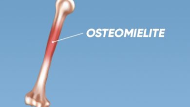Photo of O que é osteomielite